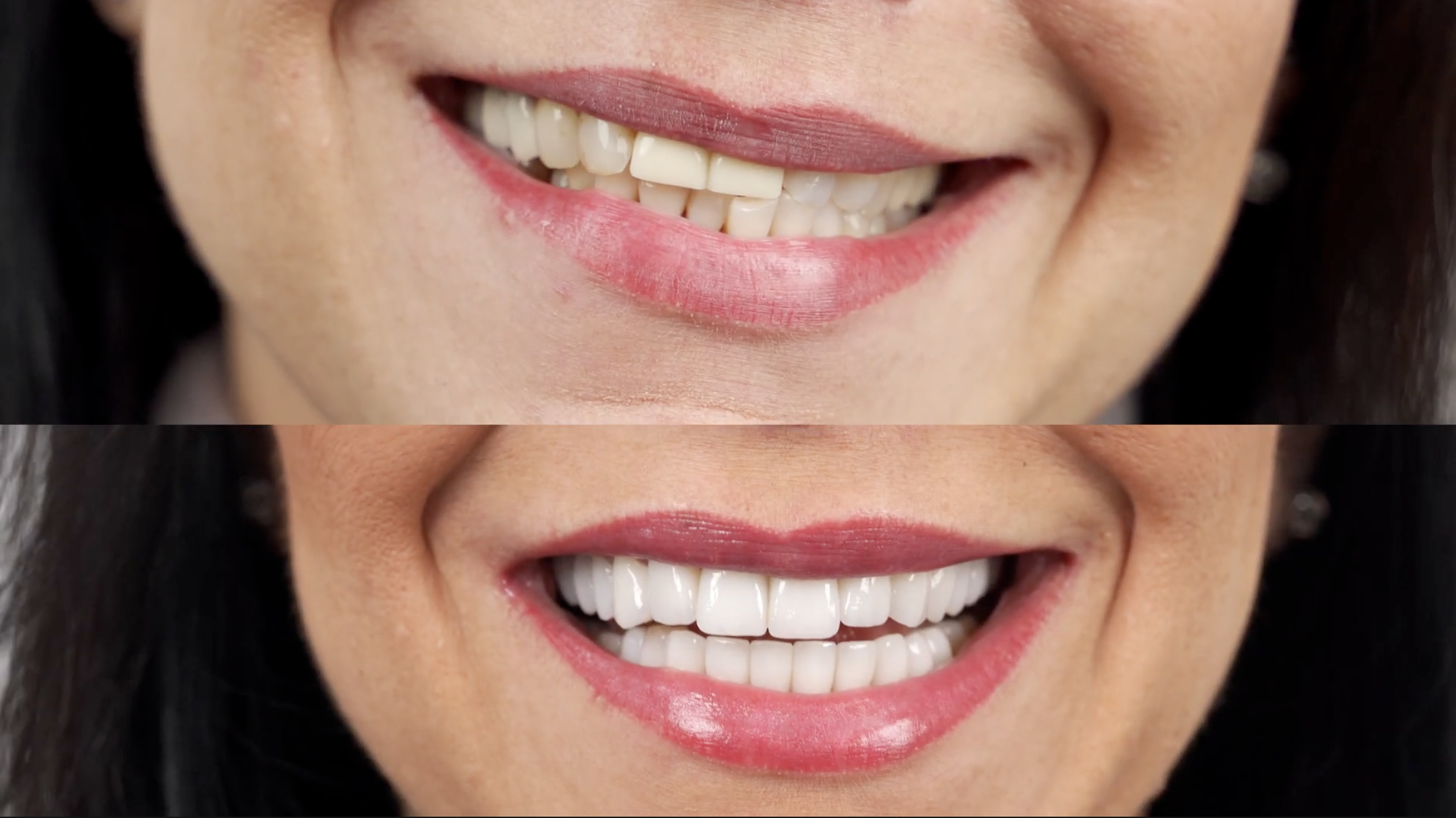 crowns vs veneers